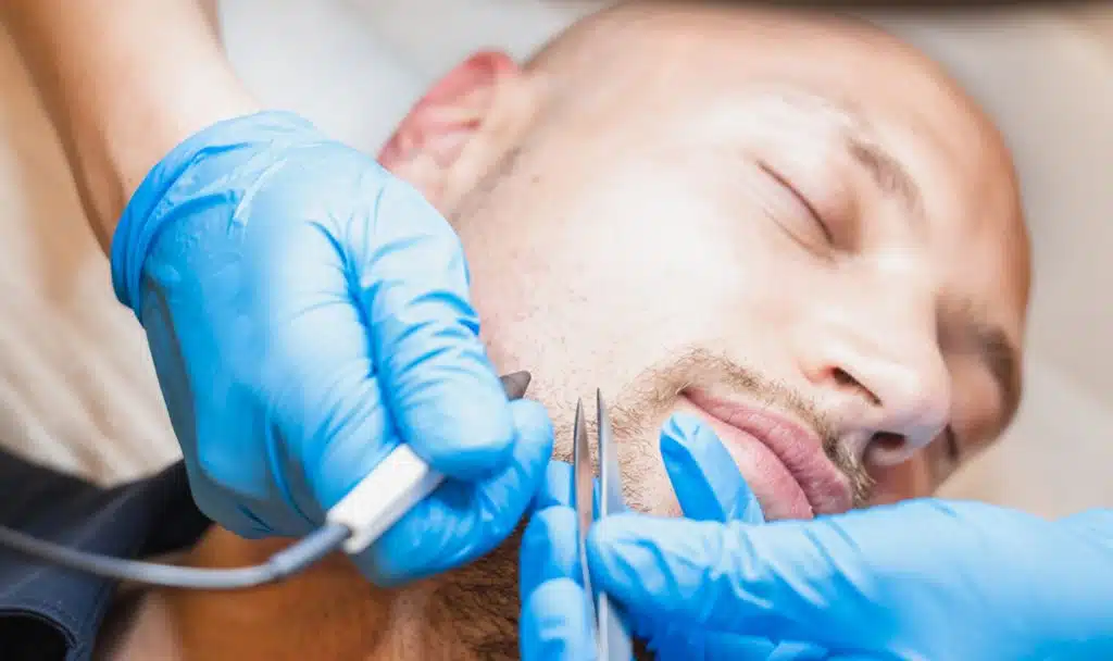 Epilation Gesicht in Erding Behandlung Haarentfernung